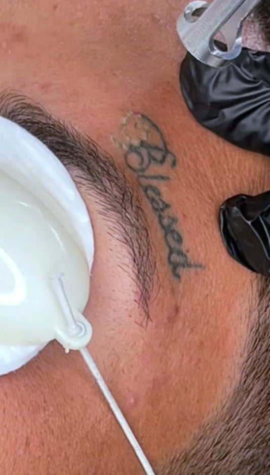 Tratamiento facial – eliminación de tatuajes