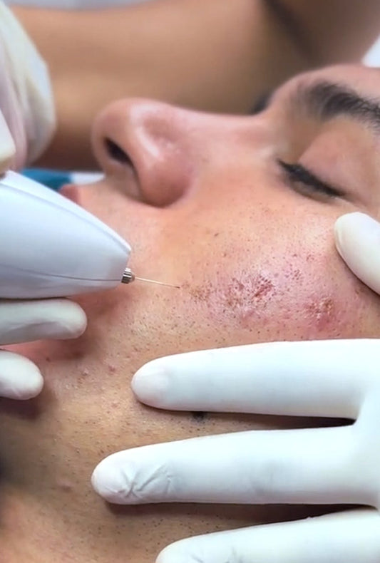 Tratamiento facial - Peeling de renovación celular para cicatrices / 5 Sesiones