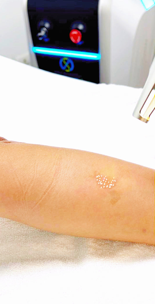 Tratamiento corporal – Manchas de nacimiento / 5 Sesiones