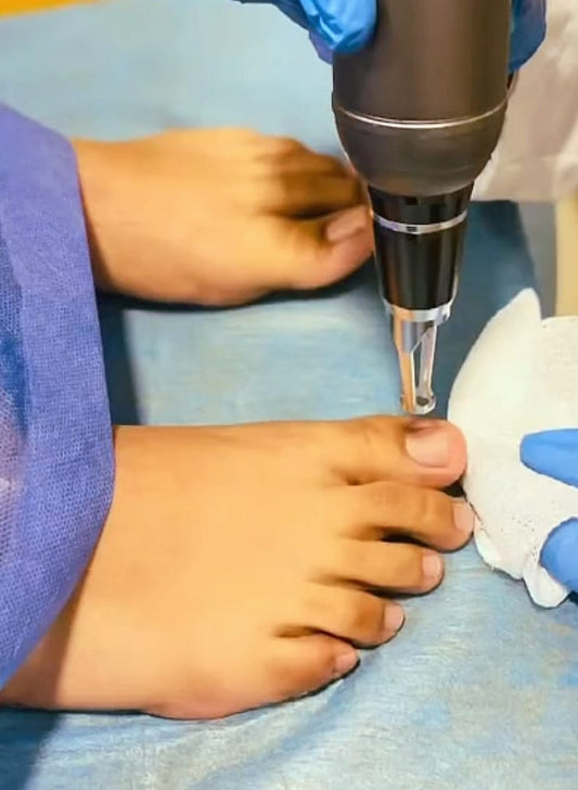 Tratamiento corporal – Onicomicosis de 4 sesiones