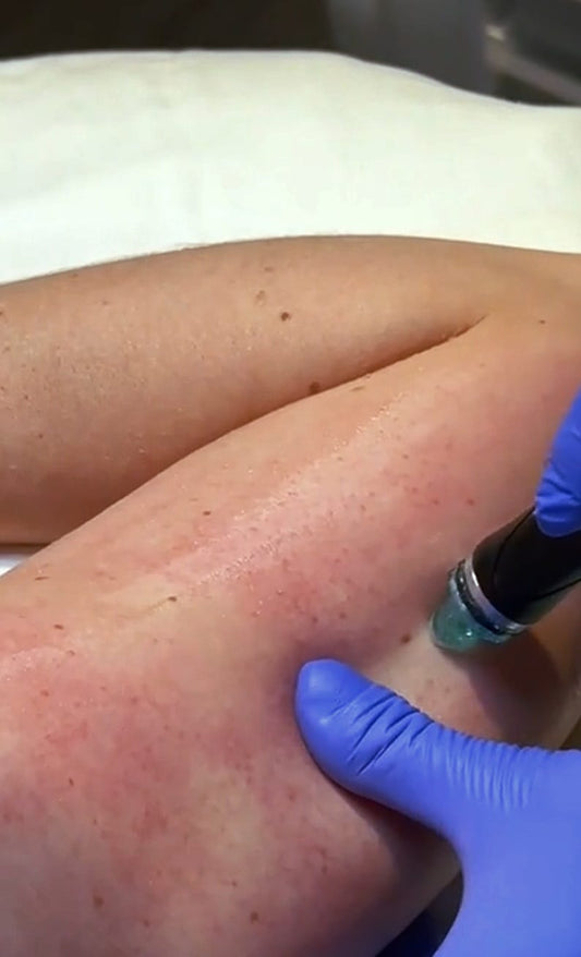 Tratamiento corporal – Queratosis Pilaris / 4 Sesiones