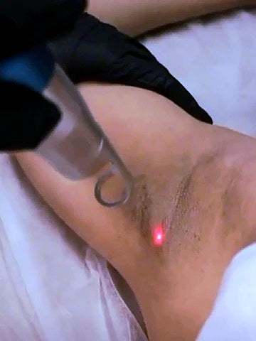 Tratamiento corporal - Despigmentación de axilas / 8 Sesiones