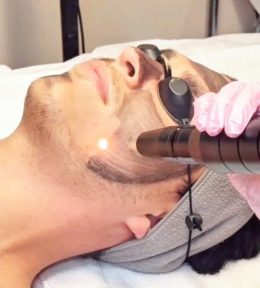 Tratamiento láser facial – Hollywood peel