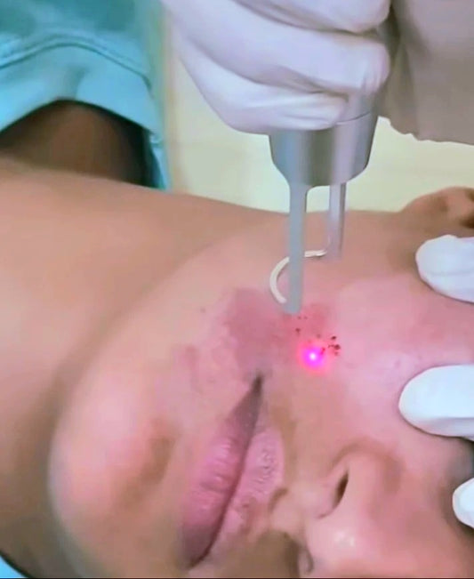 Tratamiento facial – Nevus de OTA / 5 Sesiones