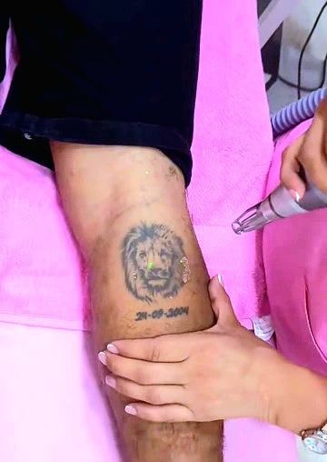 Tratamiento corporal – eliminación de tatuajes