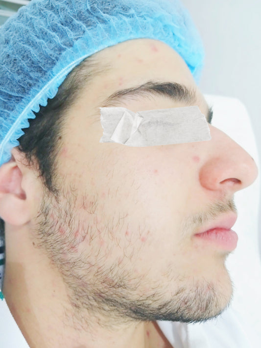 Tratamiento facial – Eliminación de secuelas de acné más hidratación profunda / 4 Sesiones