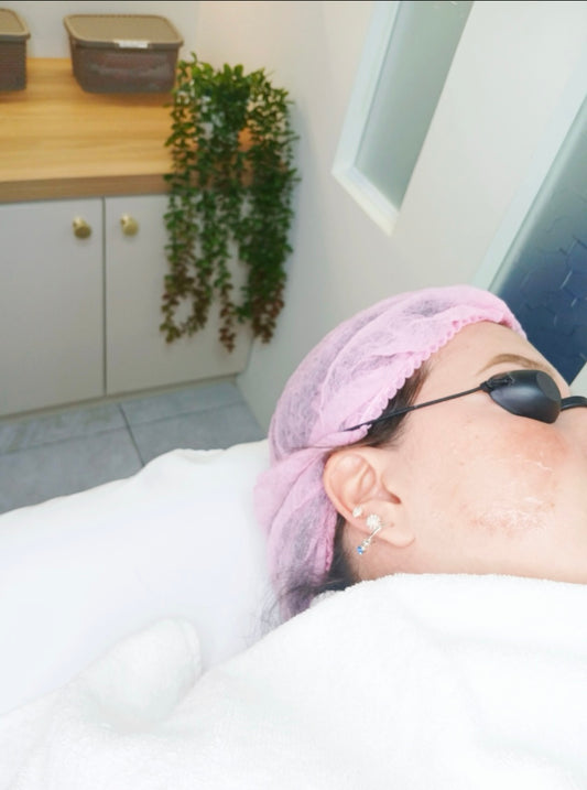 Tratamiento facial – Despigmentante / hormonal de 5 sesiones