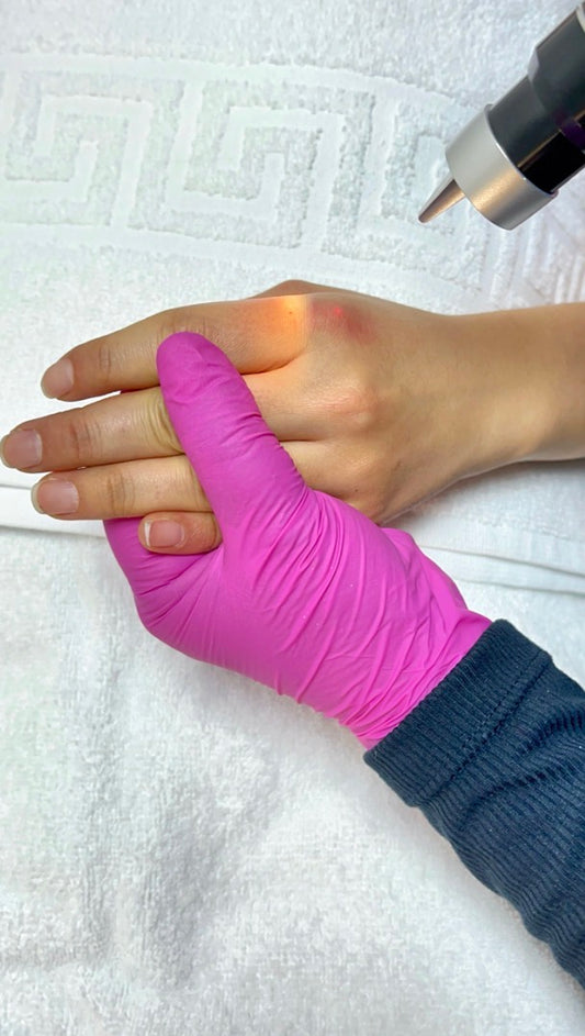 Tratamiento facial – Eliminar manchas de nacimiento / 5 Sesiones