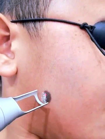 Tratamiento facial – Manchas de nacimiento / 5 Sesiones